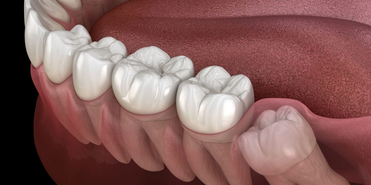 Extração de Dente Siso Quando Fazer Odonto Imperium